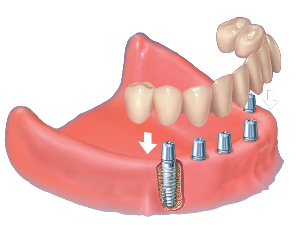 Konus-Pfosten Indikation