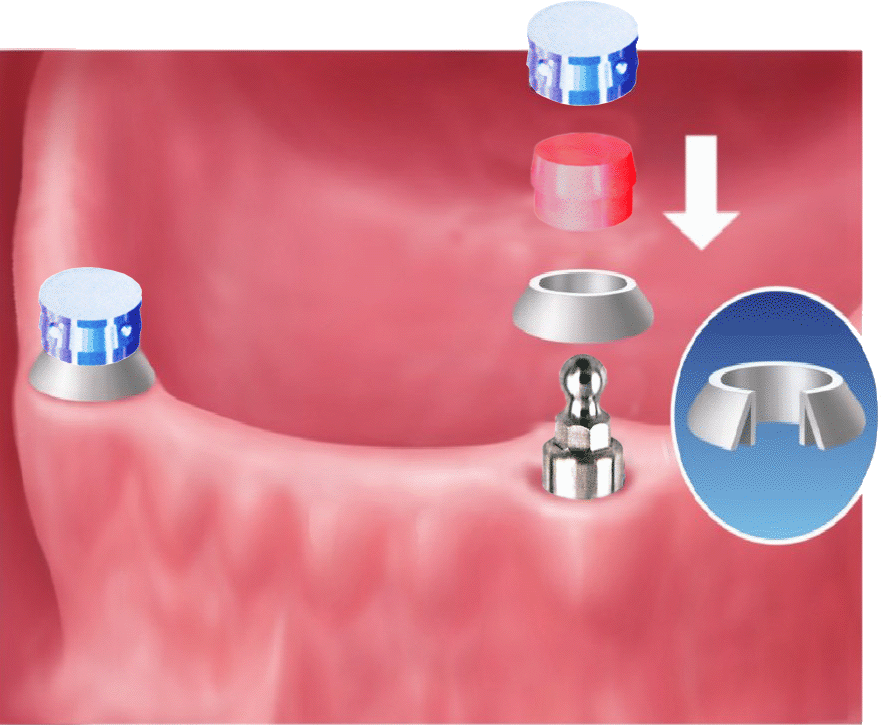 Kugel-Pfosten Indikation
