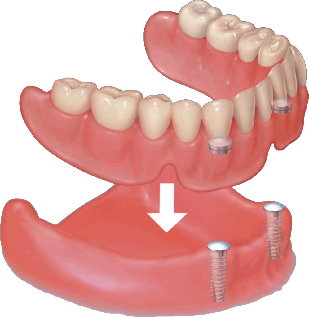 Magnet-Versorgung Indikation
