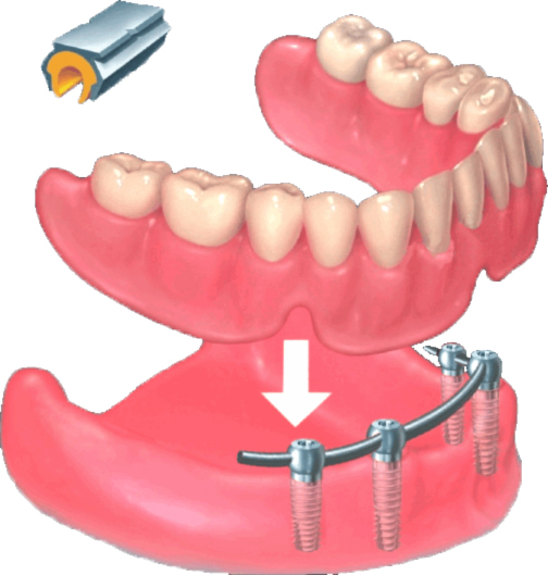 Abnehmbarer Zahnersatz