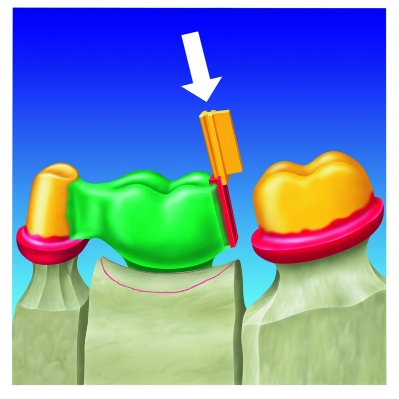 Kunststoffgeschiebe CPA-Geschiebe